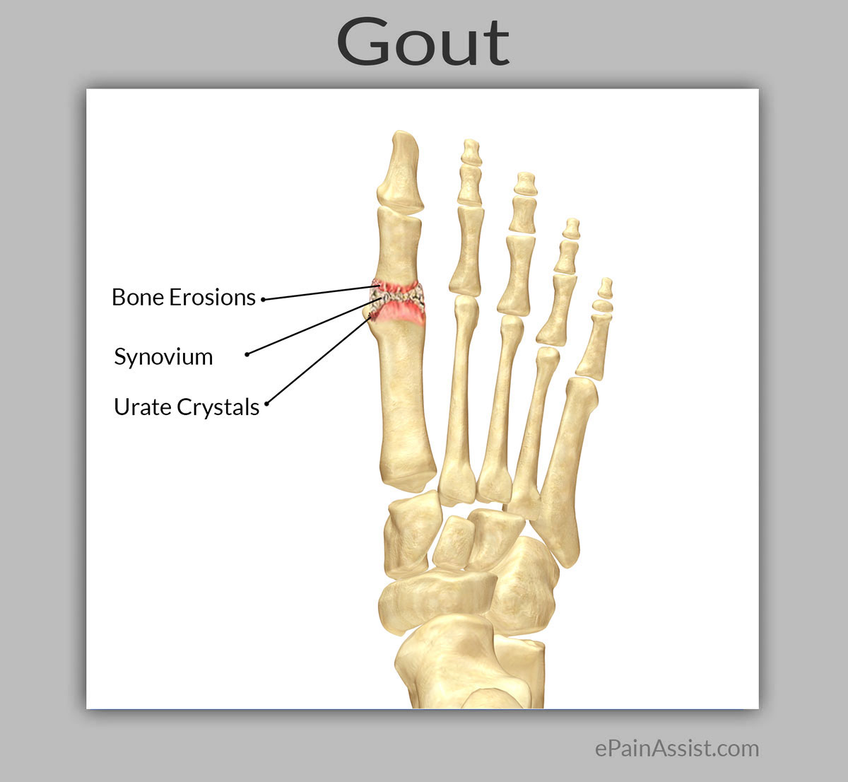 Massage Therapy for Gout Massage Therapy for Gout