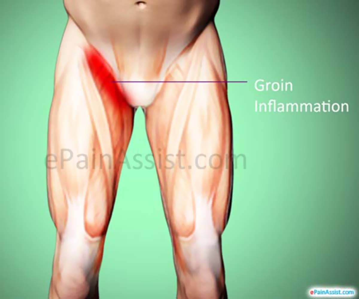 Groin Inflammation Groin Inflammation