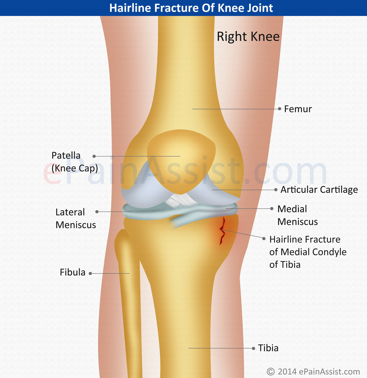 Hairline Fracture Of Knee Joint