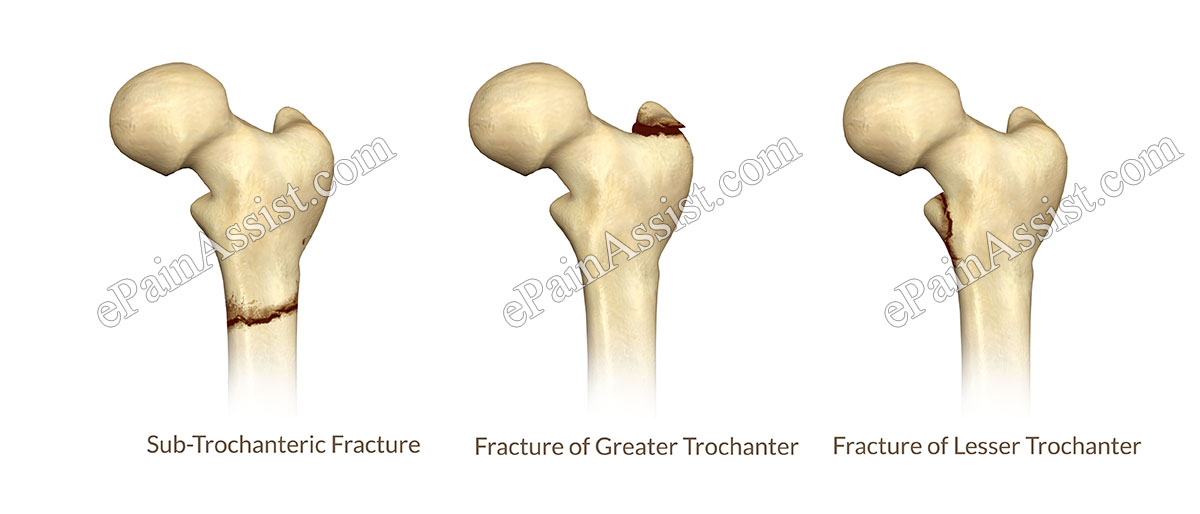 Fracture Of Femur In Hip Joint Fracture Sub-Trochanteric Fracture, Fracture of Greater and Lesser Trochanter