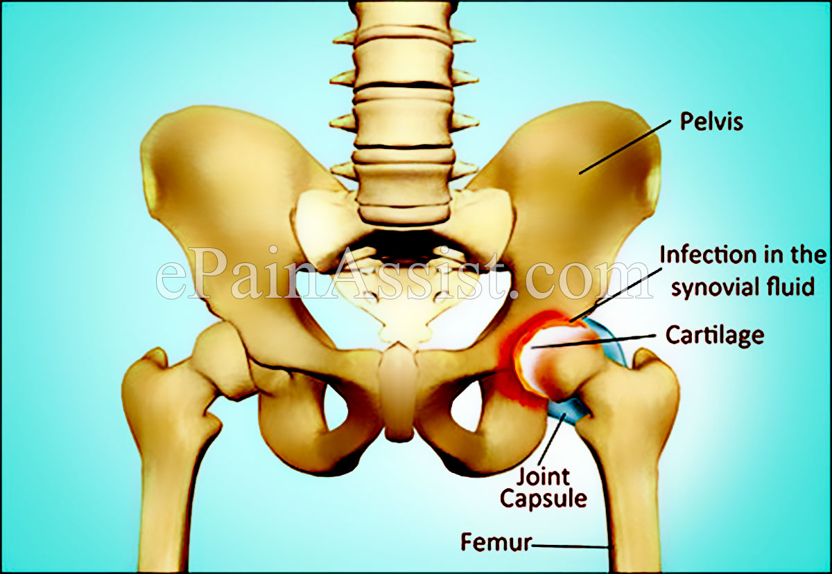 Causes of Hip Joint Septic Arthritis Causes of Hip Joint Septic Arthritis