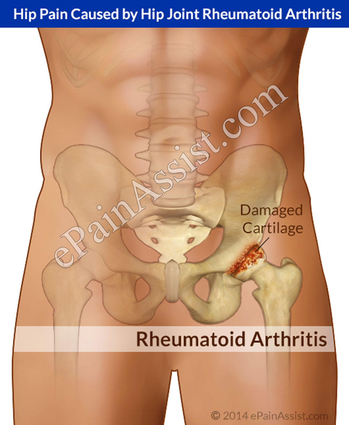 Hip Pain Caused by Hip Joint Rheumatoid Arthritis