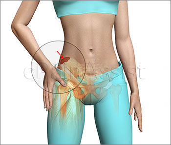 Hip Pointer or Iliac Crest Contusion Symptoms