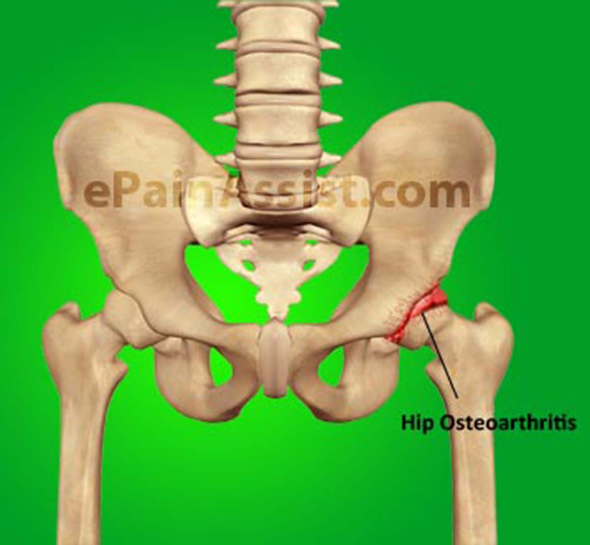 Hip Joint Osteoarthritis Hip Joint Osteoarthritis