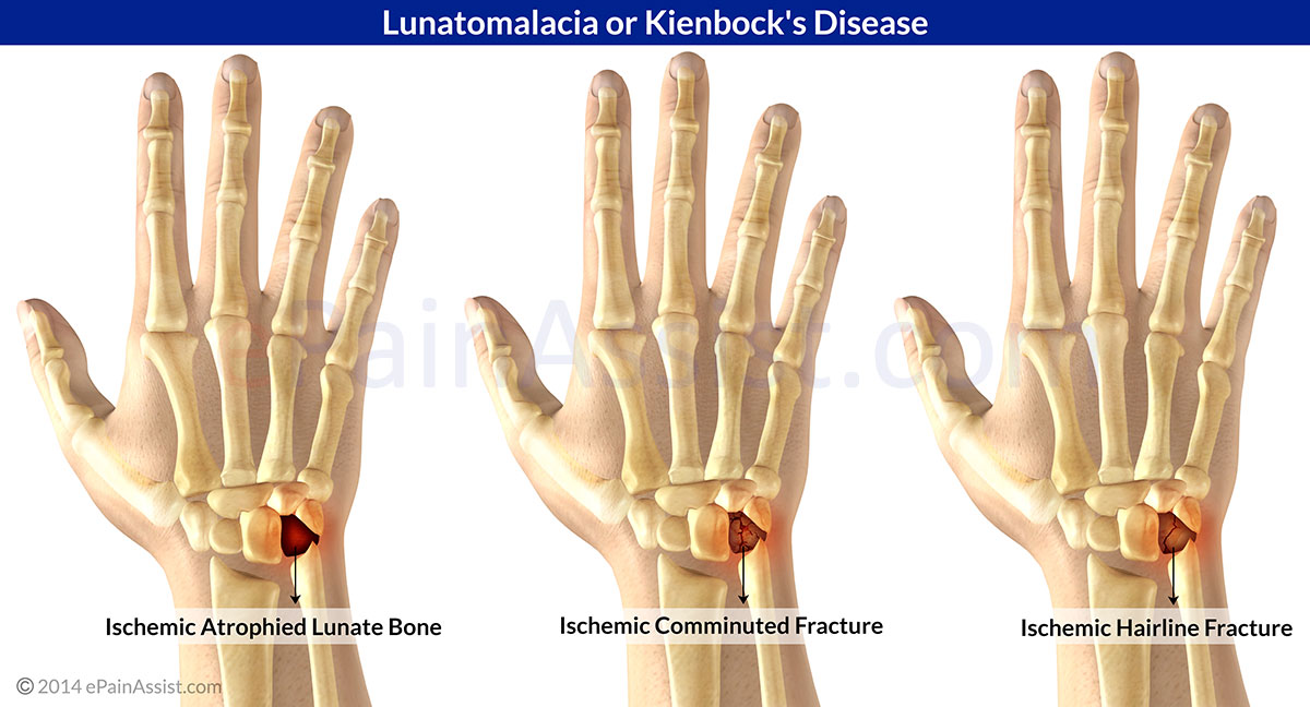 Lunatomalacia Or Kienbock s Disease Causes Symptoms Diagnosis Treatment 