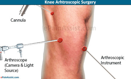 Knee Arthroscopic Surgery