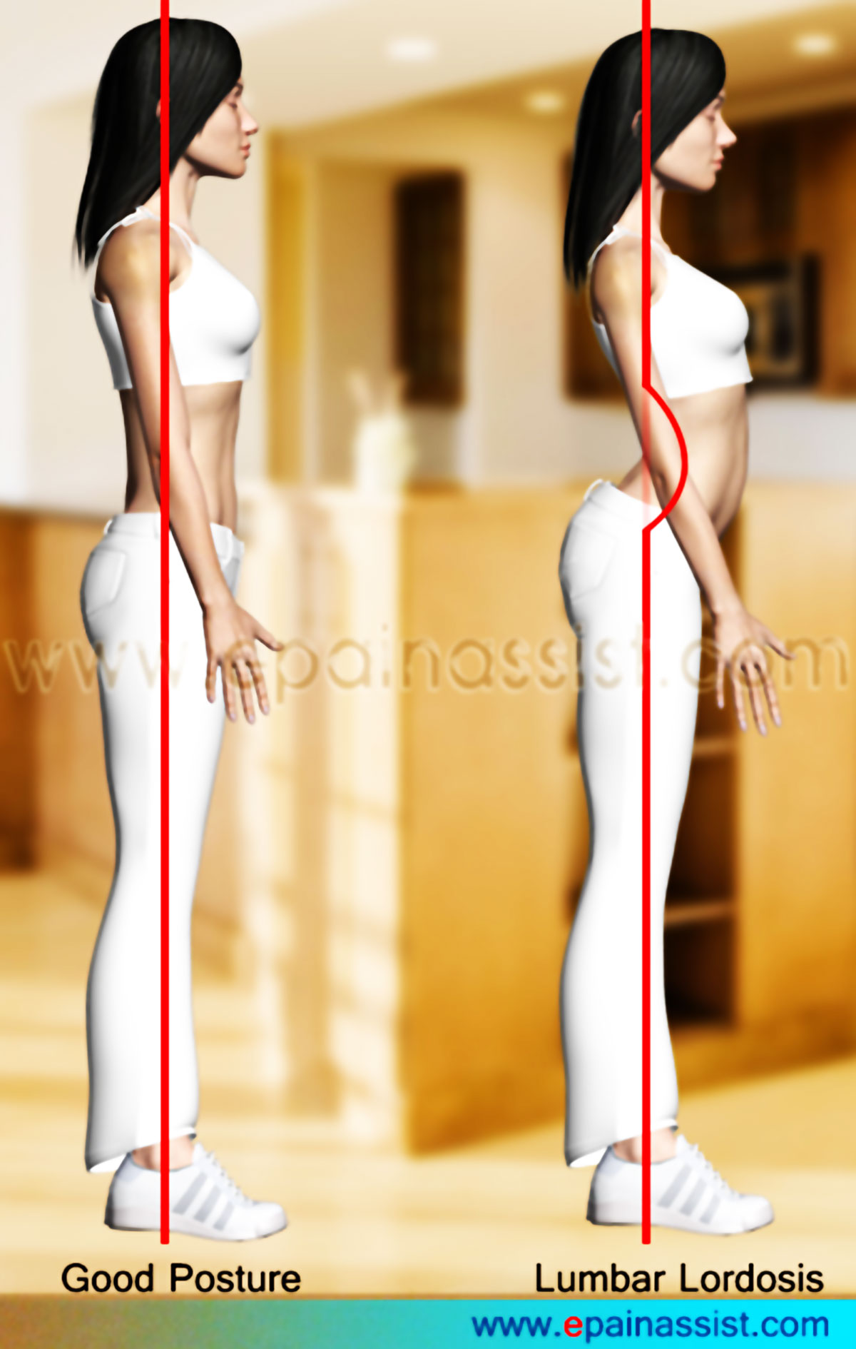 Lumbar Lordosis