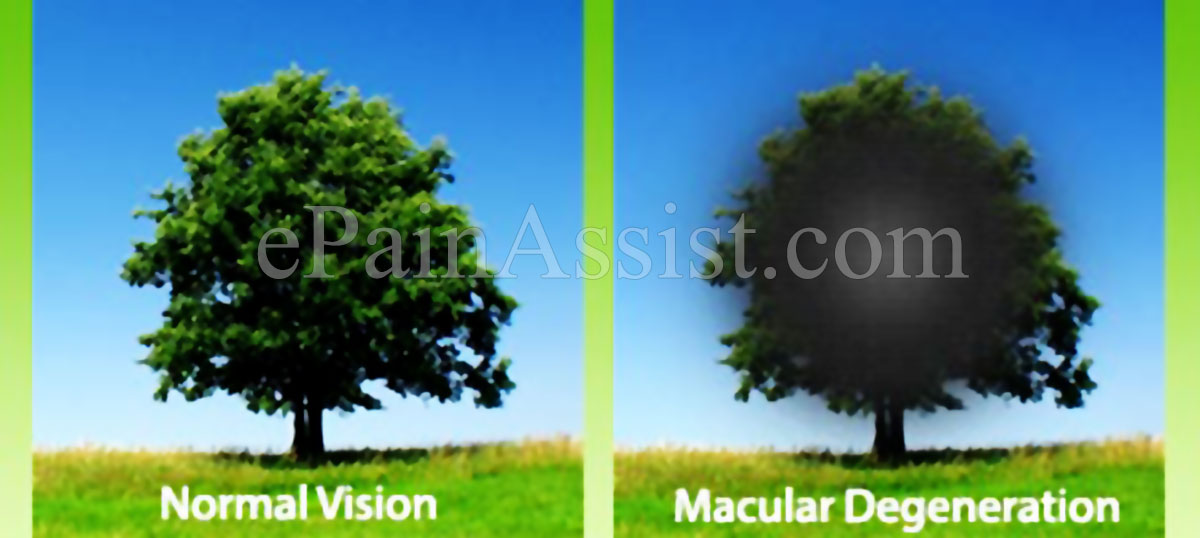 Macular Degeneration: Wet, Dry, Stages, Causes, Signs, Treatment Macular Degeneration: Wet, Dry, Stages, Causes, Signs, Treatment
