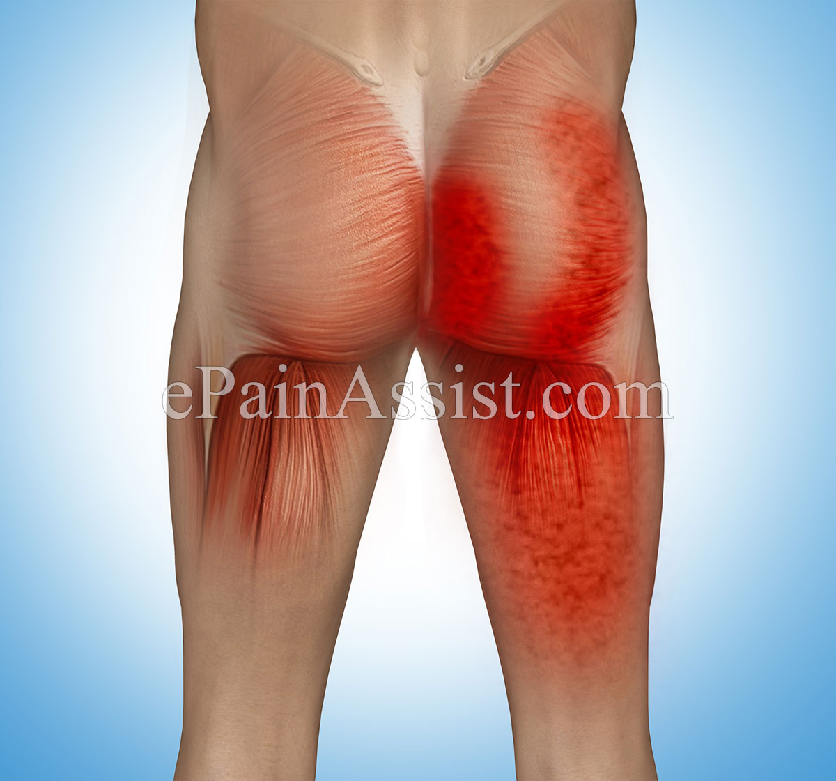 Steroid injection in hip muscle