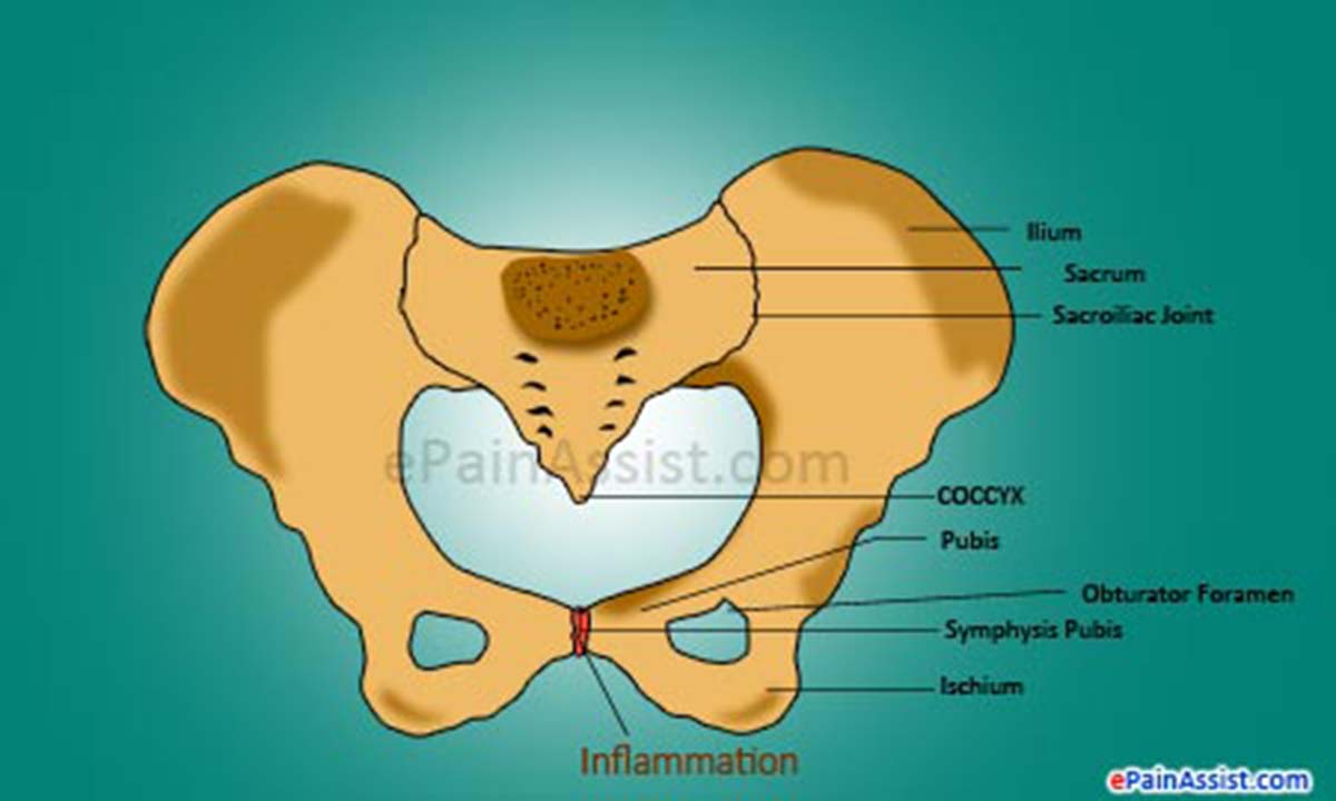 Osteitis Pubis Osteitis Pubis