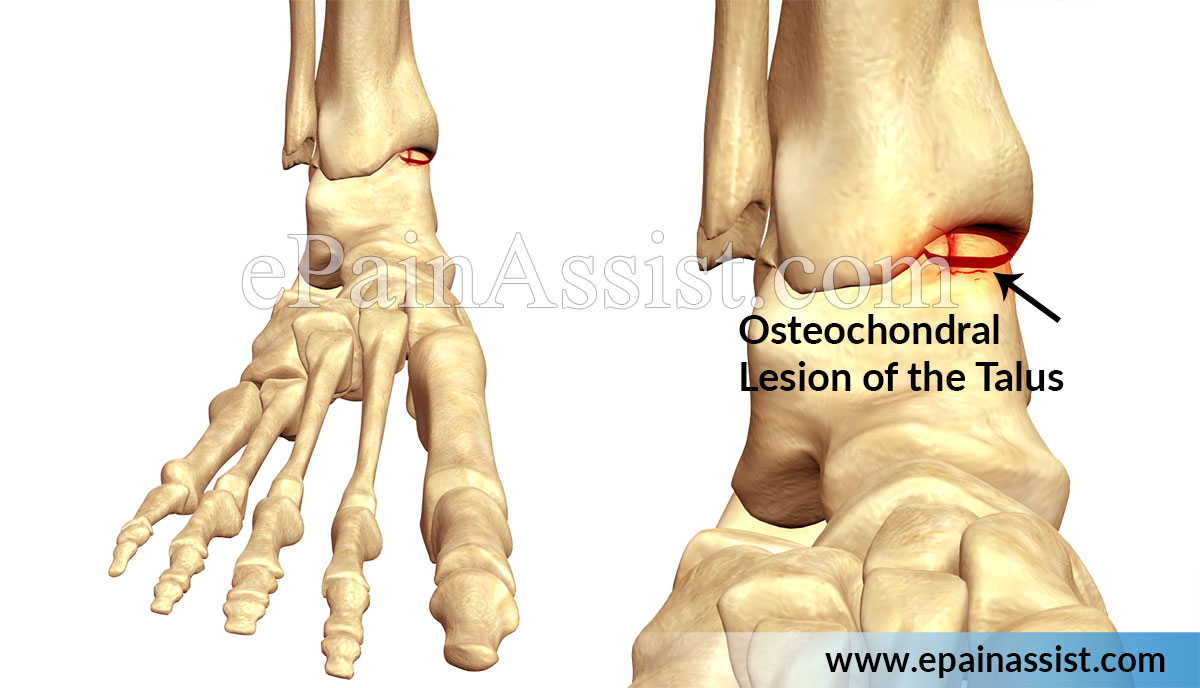 Osteochondral Lesion of the Talus (OLT) Osteochondral Lesion of the Talus (OLT)