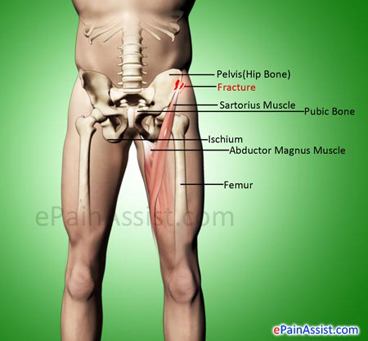 Pelvis Avulsion Fracture Pelvis Avulsion Fracture