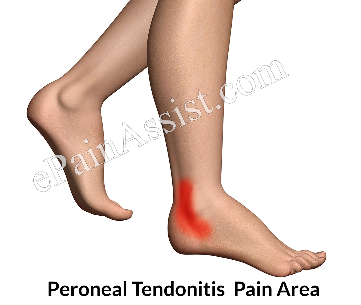 Peroneal Tendonitis or Peroneal Tendinitis: Symptoms, Causes, Treatment-NSAIDs, Massage Peroneal Tendonitis or Peroneal Tendinitis: Symptoms, Causes, Treatment-NSAIDs, Massage