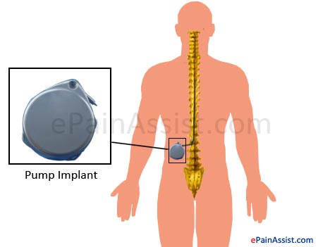 Pump Implant in Intrathecal Pain Medication