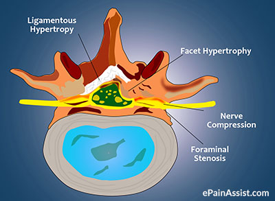 Nerve Compression