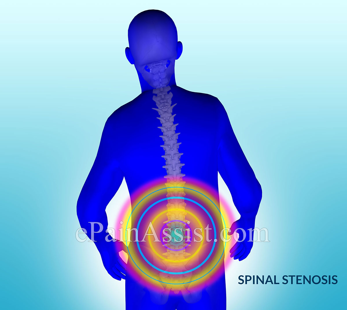 Lumbar Spinal Stenosis