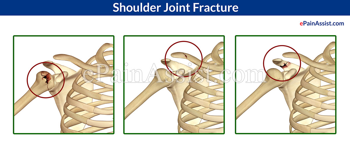 Shoulder Joint Fracture Shoulder Joint Fracture