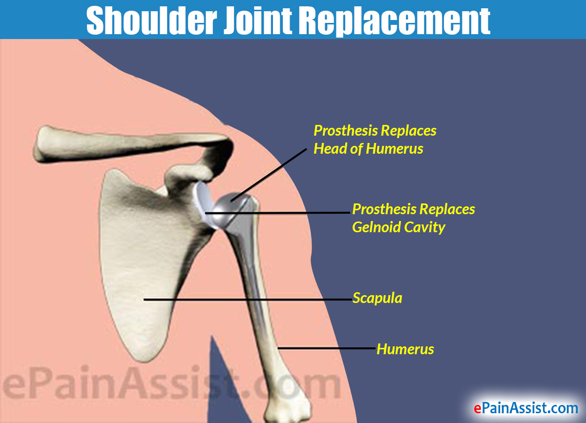 Shoulder Joint Replacement