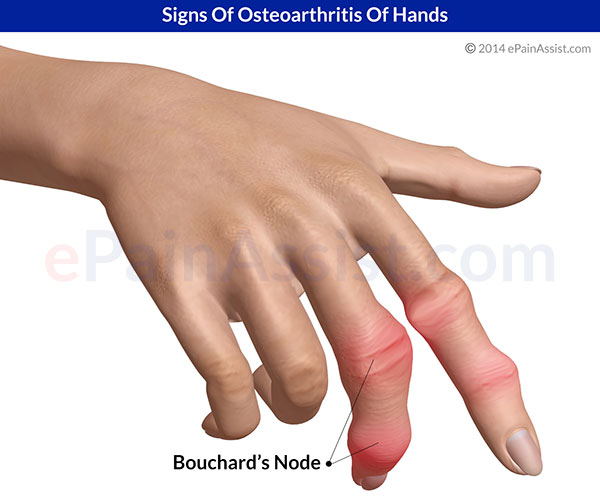 Signs Of Osteoarthritis Of Hands