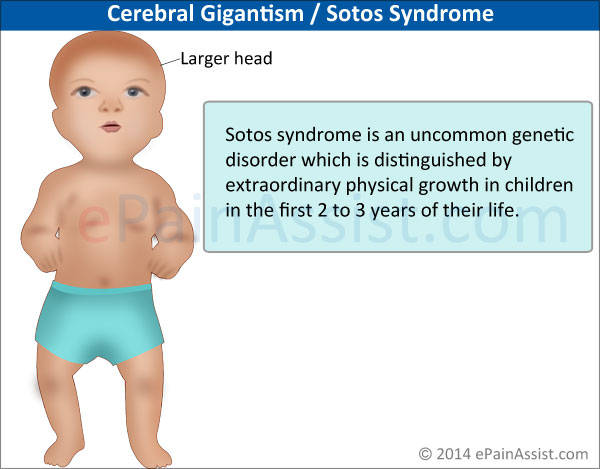 Sotos Syndrome or Cerebral Gigantism