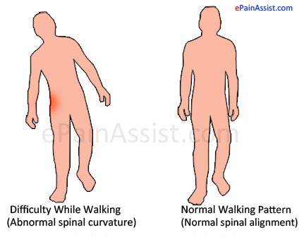 Hip Synovitis Symptoms: Difficulty While Walking