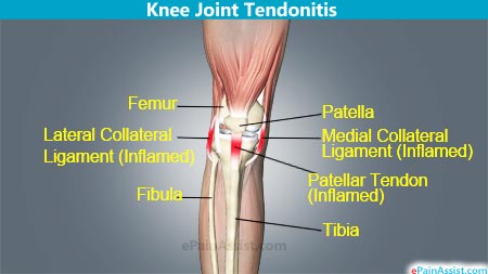 Tendonitis Of Knee Joint