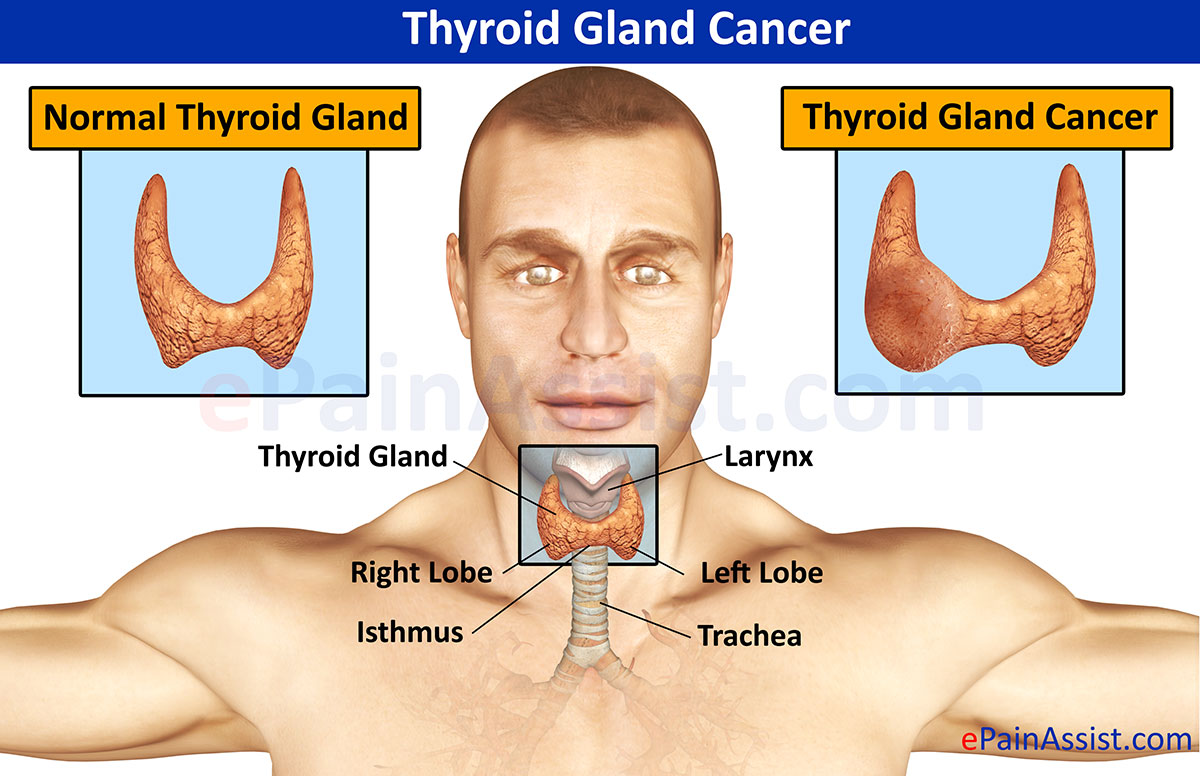 Thyroid Gland Cancer