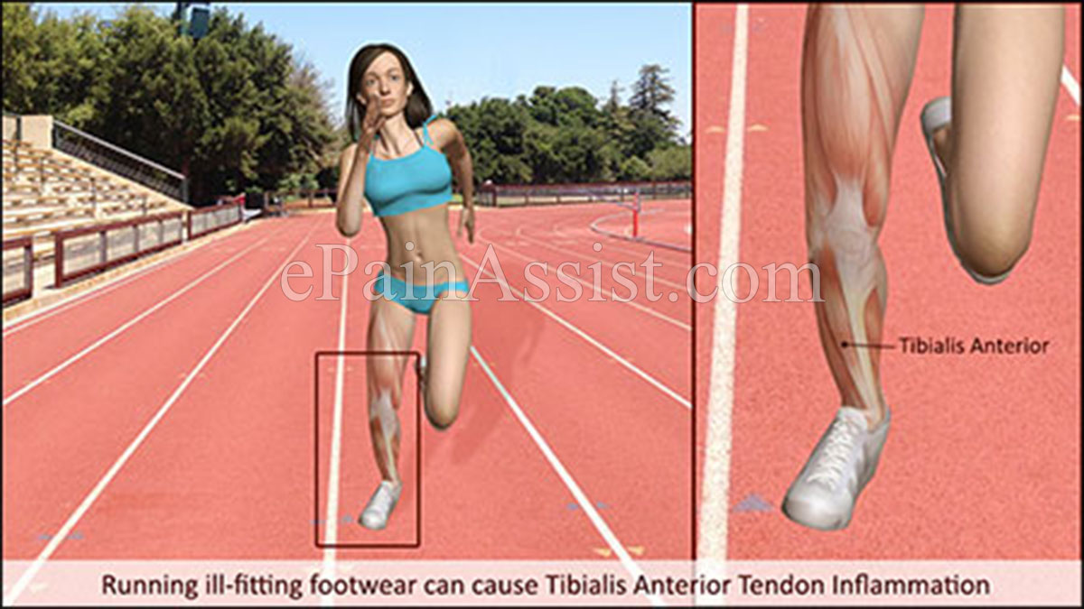 Running ill-fitting footwear can cause Tibialis Anterior Tendon Inflammation.