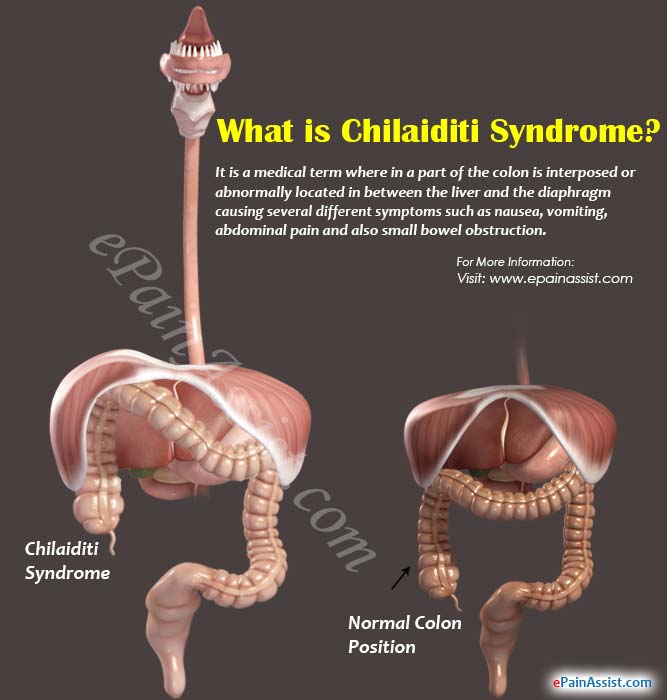 syndrome de chilaiditi définition - syndrome de chilaiditi traitement