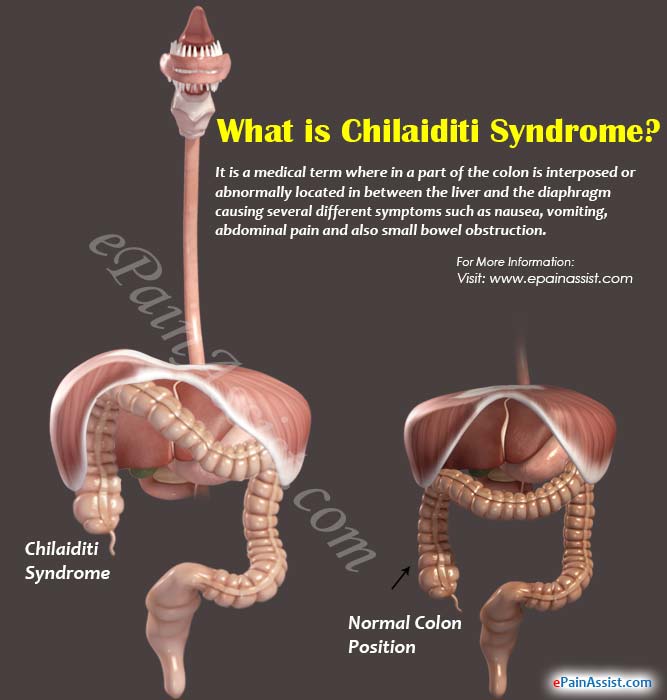 What is Chilaiditi Syndrome