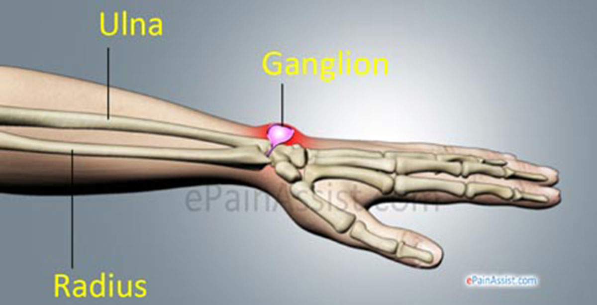 Wrist Ganglion Wrist Ganglion