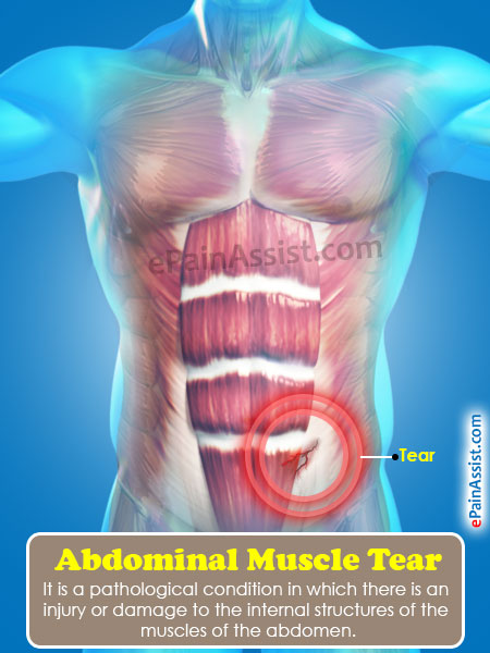 Abdominal Muscle Tear