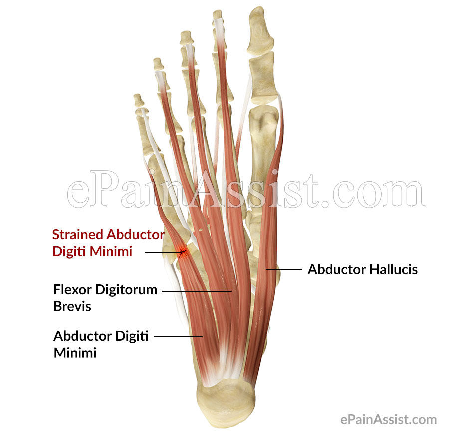 Strained Abductor Digiti Minimi Muscle of the Foot