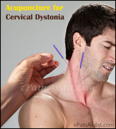 Acupuncture for Cervical Dystonia or Spasmodic Torticollis