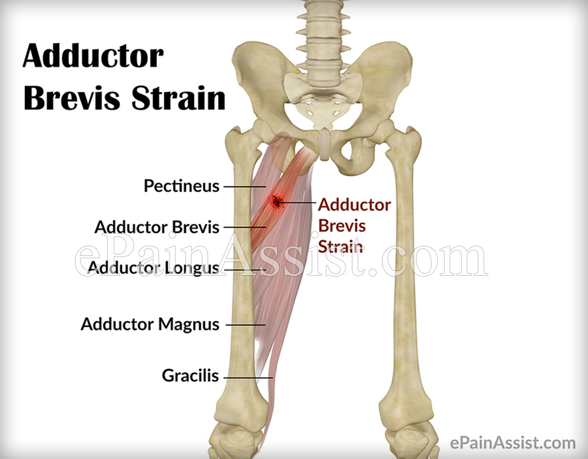 Adductor Brevis Strain
