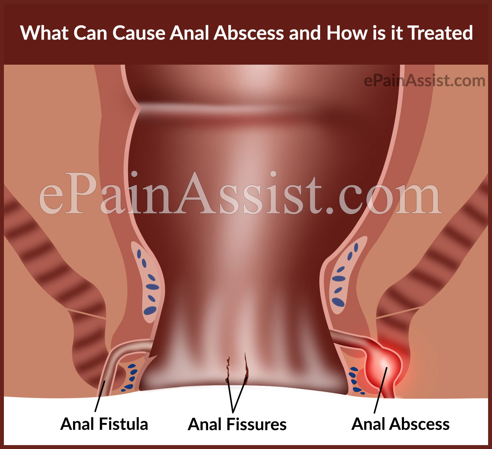 Pus near the anus