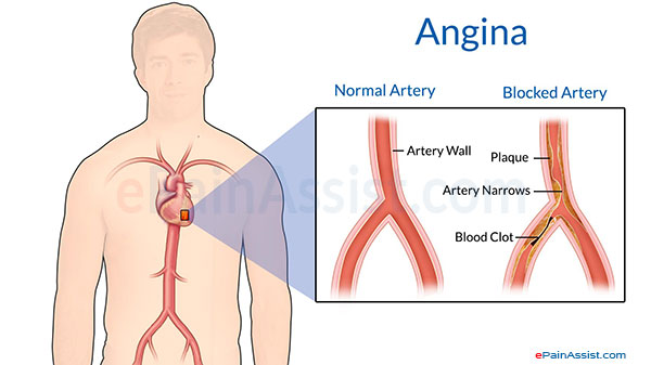 Angina