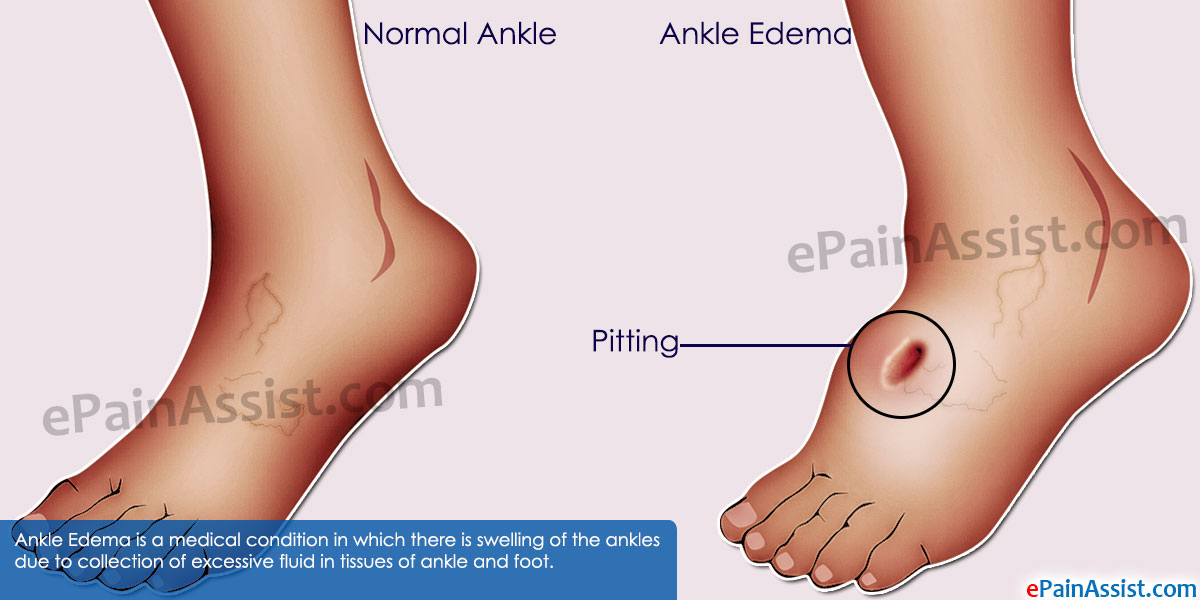 Ankle Edema