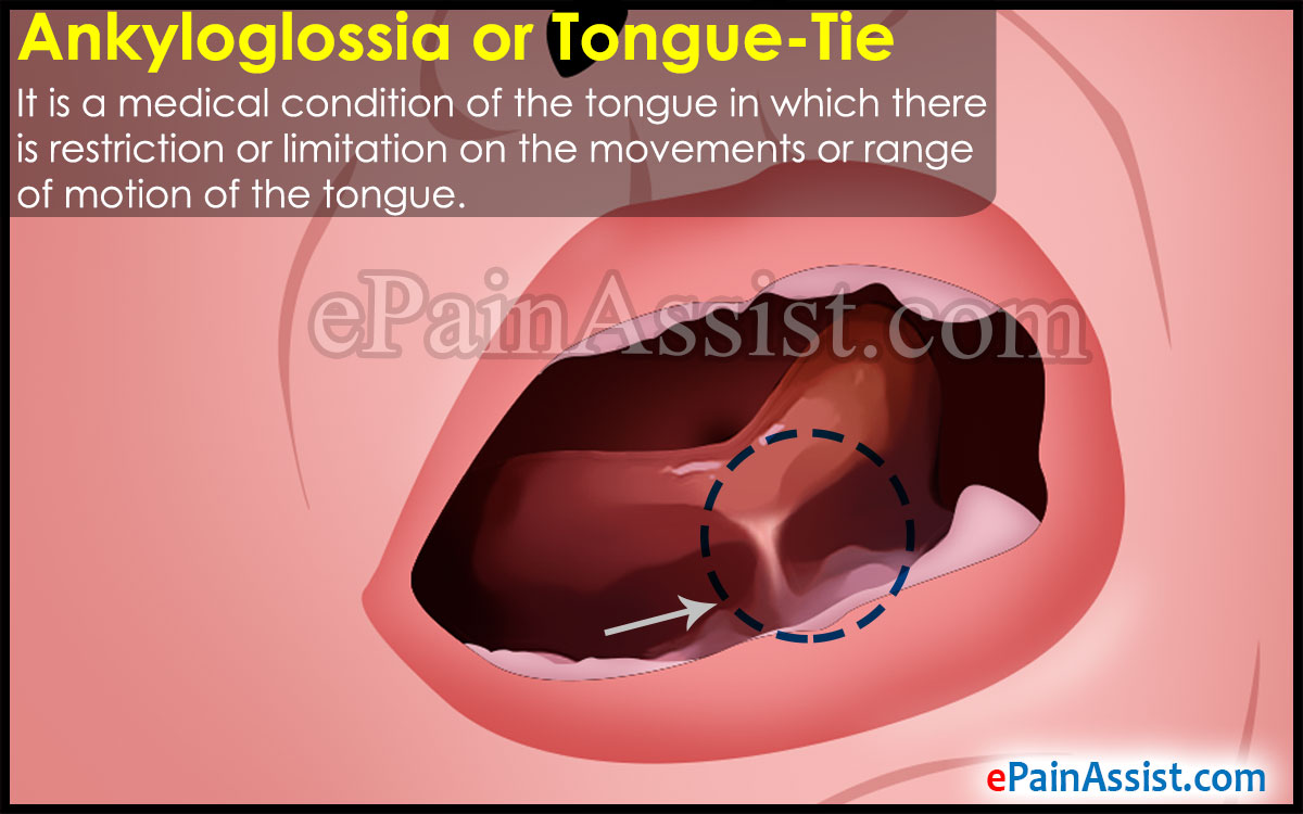 Ankyloglossia or Tongue-Tie