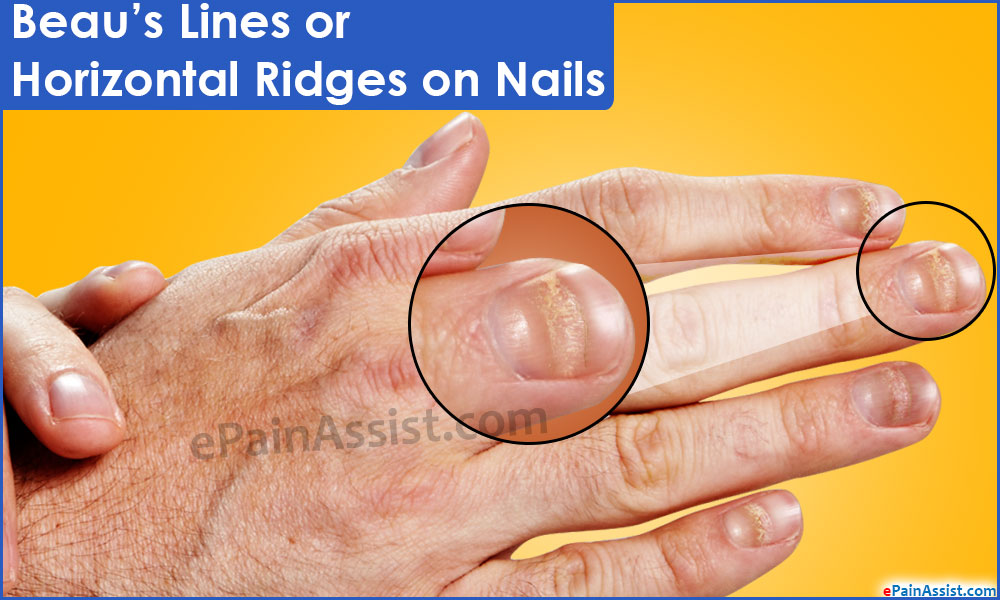 Beaus Lines Or Horizontal Ridges On Nails