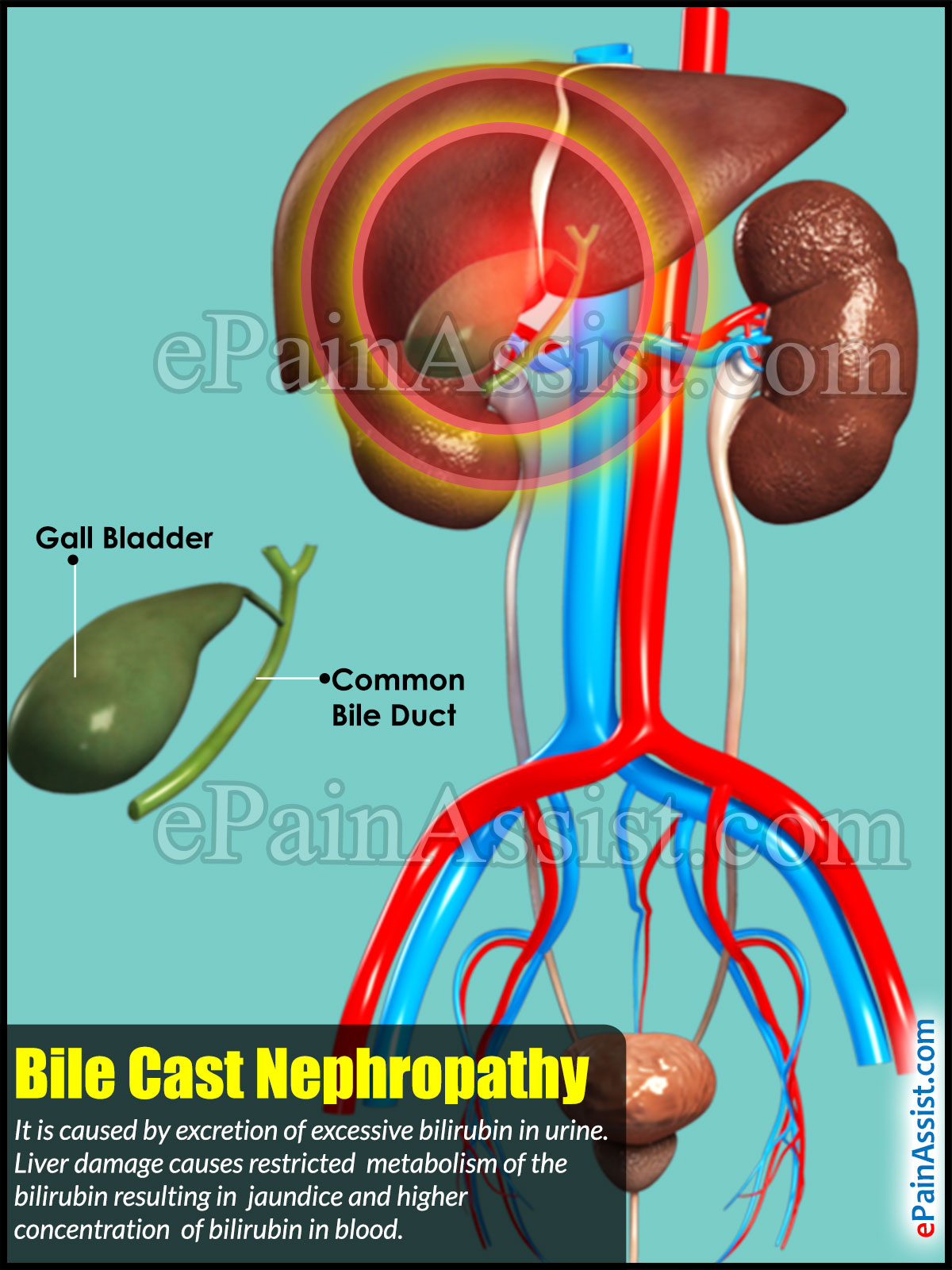 Bile Cast Nephropathy Bile Cast Nephropathy