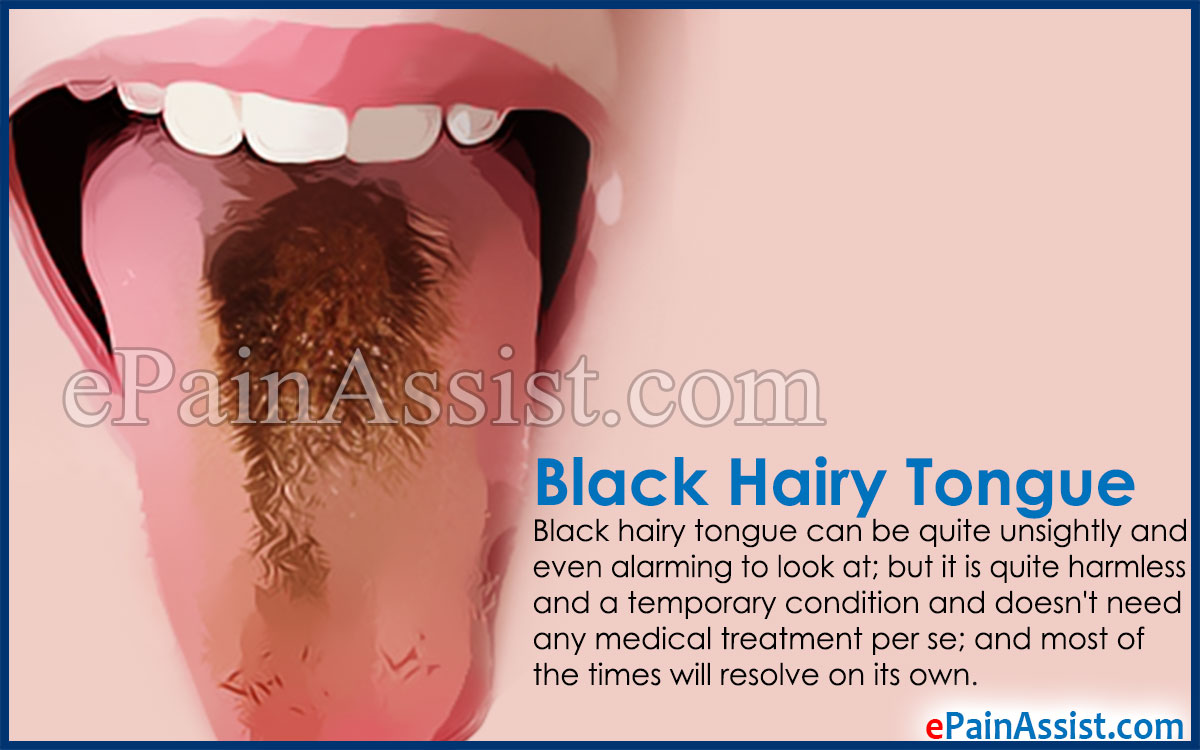 Black Hairy Tongue Black Hairy Tongue