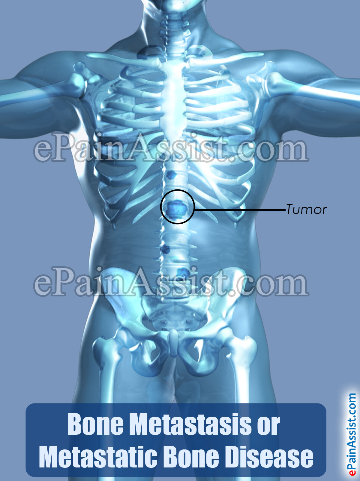Bone Metastasis or Metastatic Bone Disease Bone Metastasis or Metastatic Bone Disease