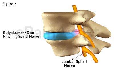 Bulge Lumbar Disc pinching spinal nerve