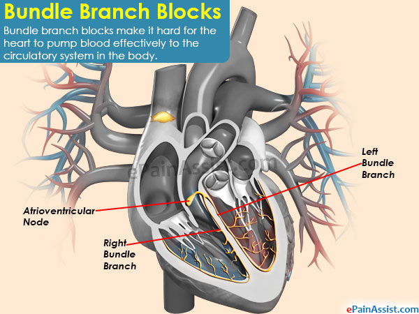 Bundle Branch Blocks