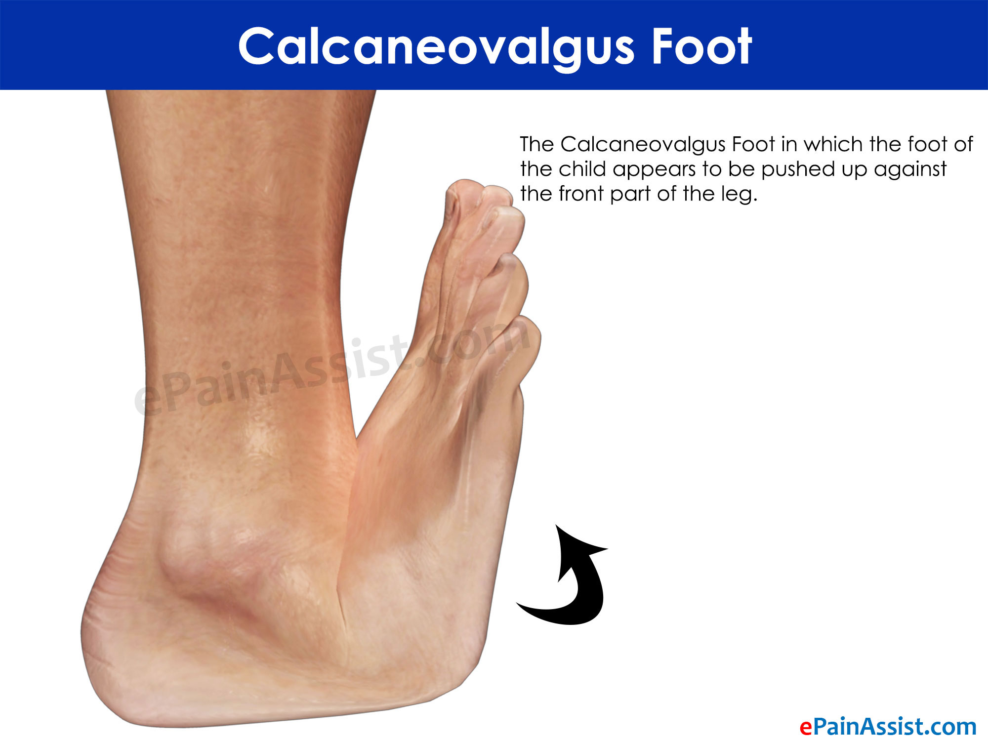 Calcaneovalgus Foot