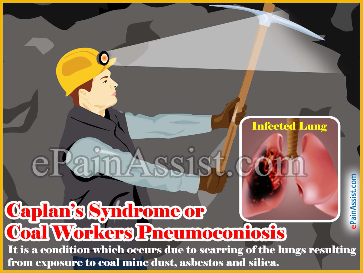 Caplan’s Syndrome or Coal Workers Pneumoconiosis Caplan’s Syndrome or Coal Workers Pneumoconiosis