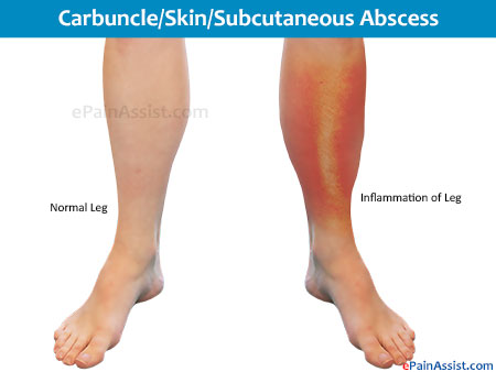 Partial Leg Pain Caused by Skin Abscess (Carbuncle)