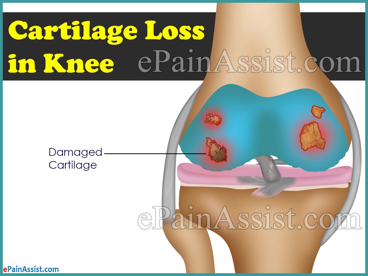 Cartilage Loss in Knee or No Cartilage in Knee Cartilage Loss in Knee or No Cartilage in Knee