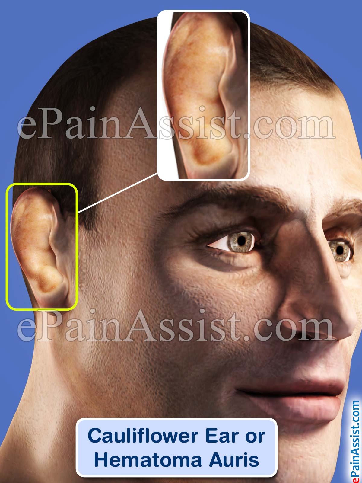 Cauliflower Ear or Hematoma Auris Cauliflower Ear or Hematoma Auris